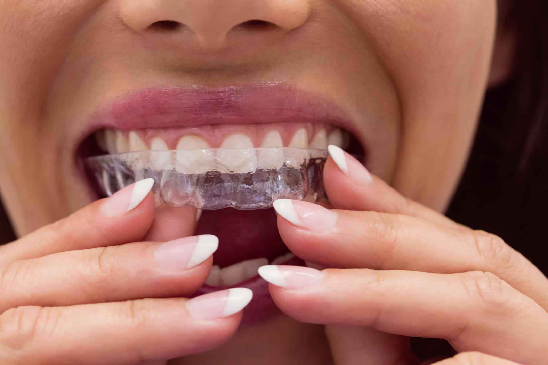 What Makes Invisalign Teeth Straightening Unique? - Oak Tree