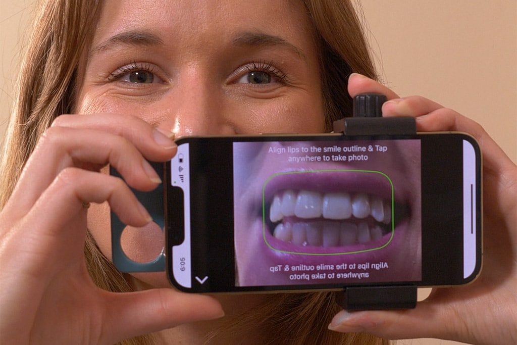 Lingual Braces